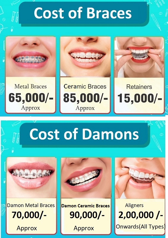 Cost of Braces